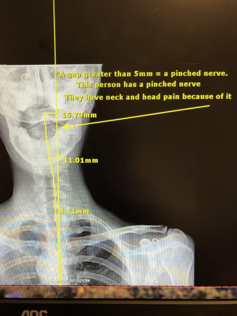 An alignment issue causes a pinched nerve which in turn causes neck pain